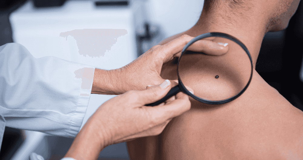 Grains de beauté : comment en prendre soin ?