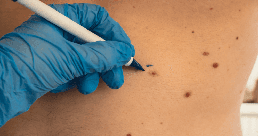 cancer peau évolution