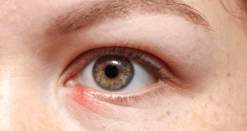 Le chalazion de quoi s'agitil — free download