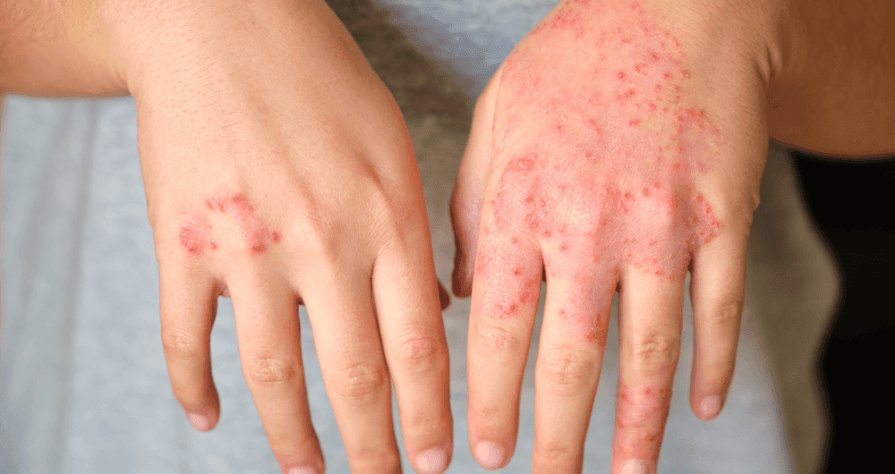 Diagnostic et traitement de la dermatite atopique