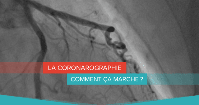 Coronarographie : qu'est-ce que c'est