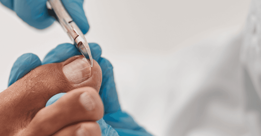 [Webinaire] Onychomycoses : un dermatologue répond à vos questions