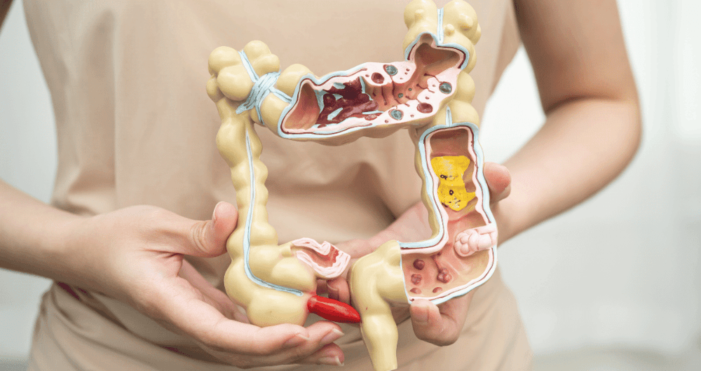 Prolapsus stomial : causes, symptômes et solutions