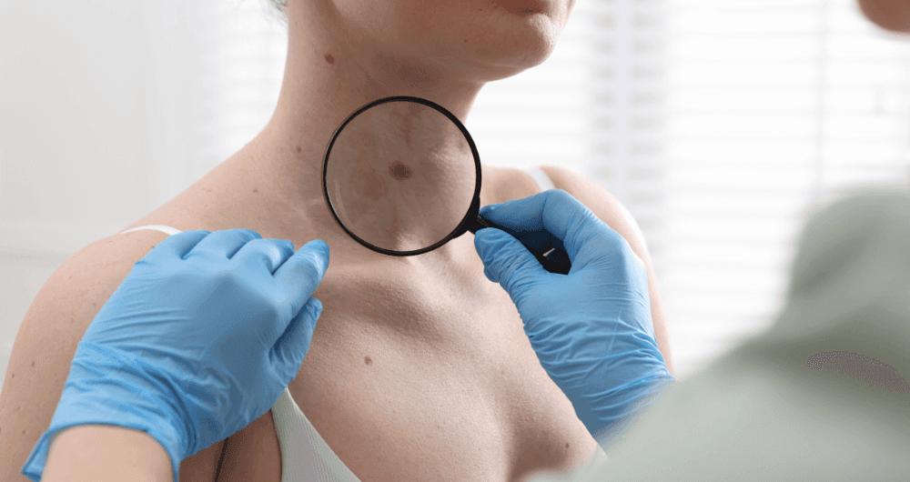 symptômes cancer peau