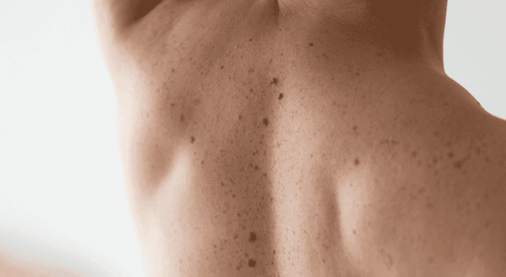 Biopsie de la peau : que se passe-t-il avant, pendant et après ?