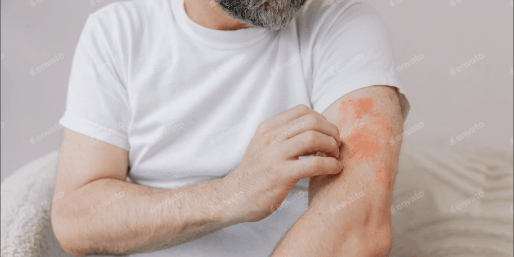 Comprendre le psoriasis, cette maladie inflammatoire de la peau
