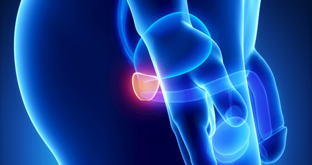 cancer prostate traitement innovation