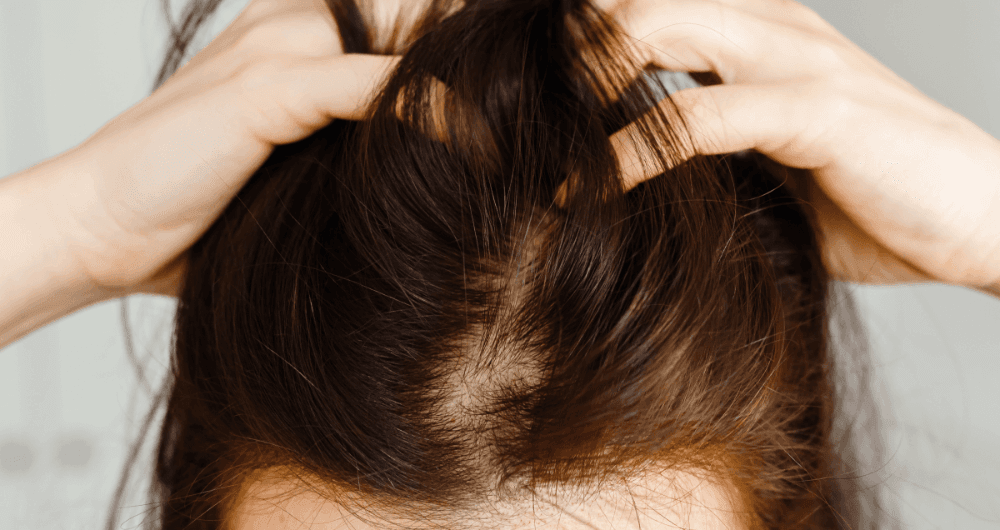 psoriasis cuir chevelu