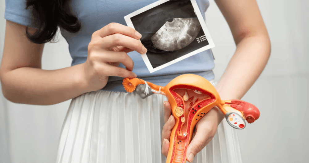 sopk et fertilité