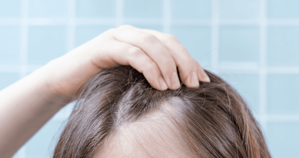 SOPK et perte de cheveux : comprendre et traiter l'alopécie