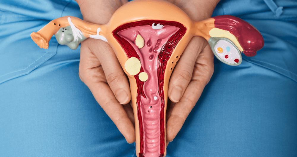 SOPK : un syndrome inflammatoire ?