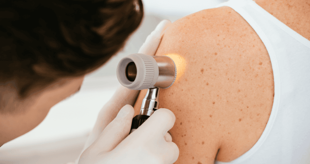Traitement du cancer de la peau : guide pour bien comprendre