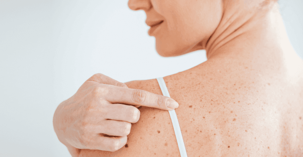 mélanome webinaire médecin